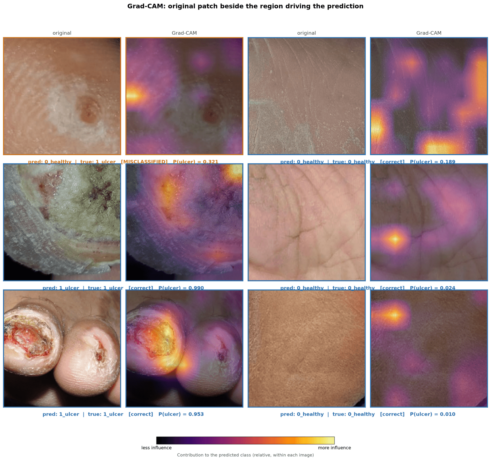 Paired skin patches and Grad-CAM attention maps, showing where the model attended for each classification